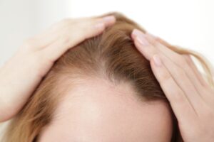 tipos alopecia