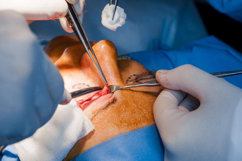Blefaroplastia