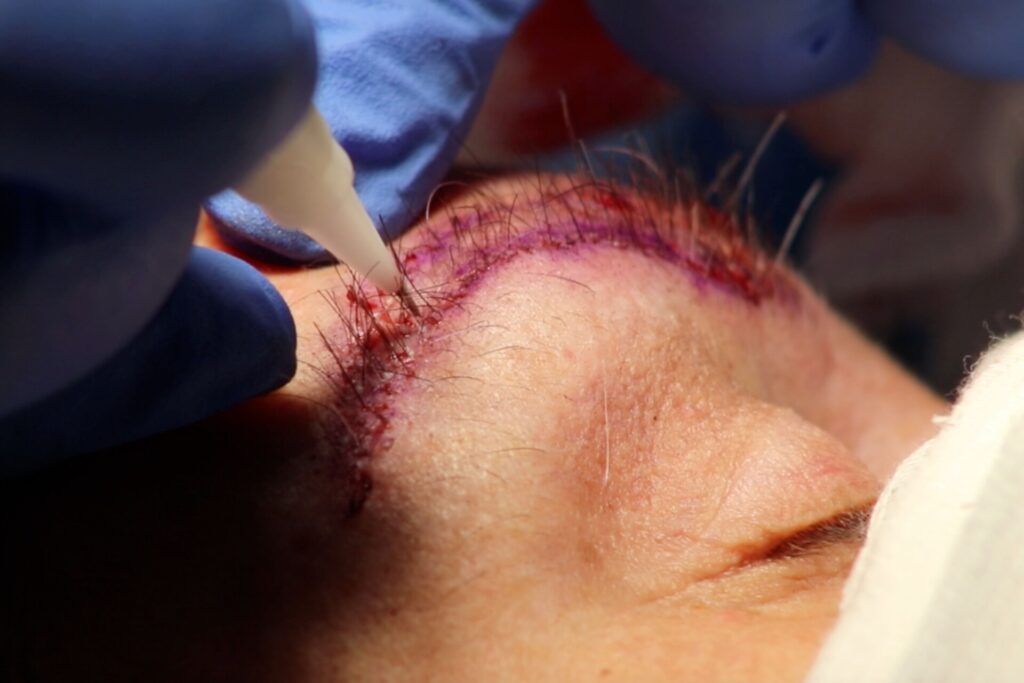 Cirugia capilar cejas Cirugia capilar cejas