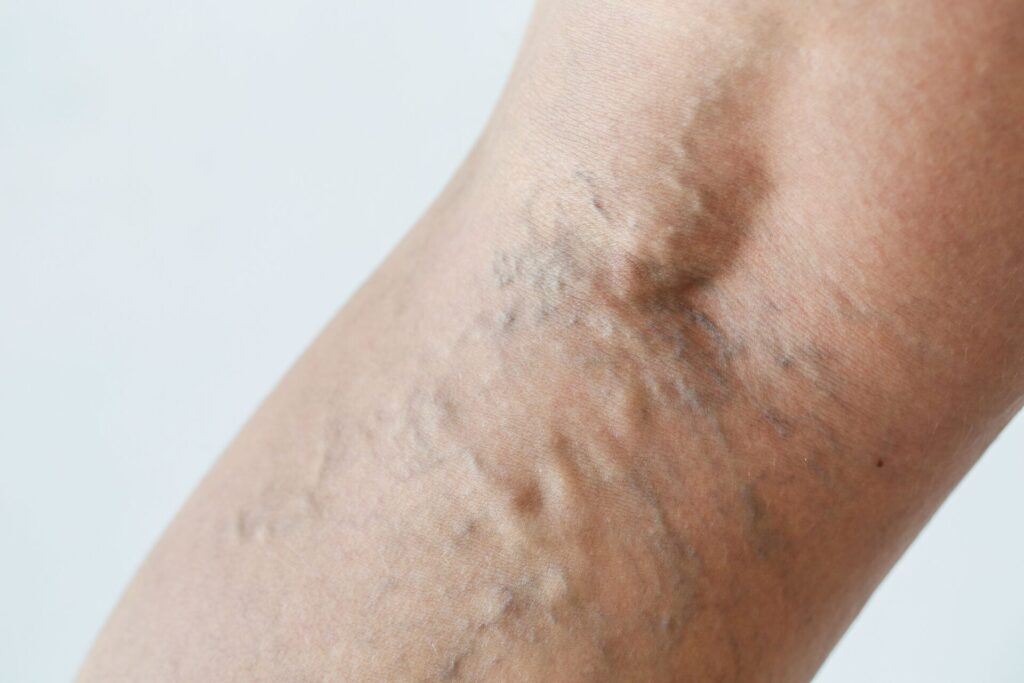 varices