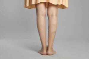 varices