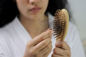 alopecia androgenica femenina