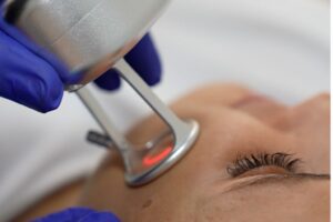 como queda la piel después del laser co2