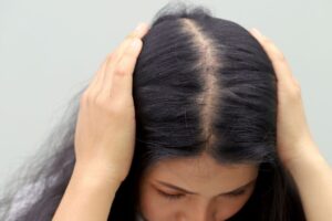 alopecia femenina soluciones