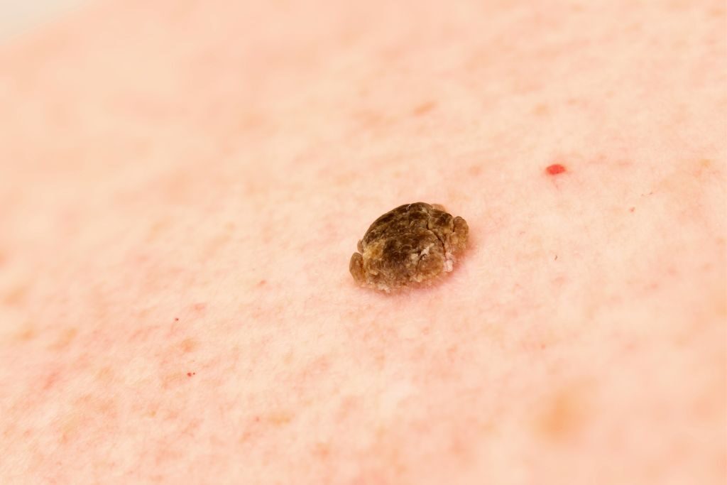 tipos de queratosis