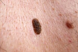 Tipos de queratosis