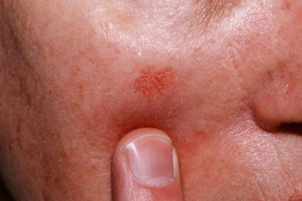 como tratar queratosis actinica