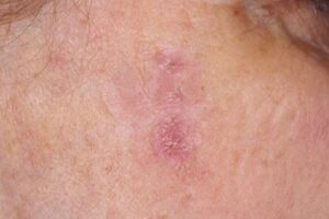 como tratar queratosis actinica