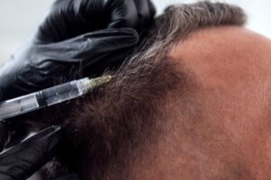 Blog 14 mesoterapia capilar con exosomas