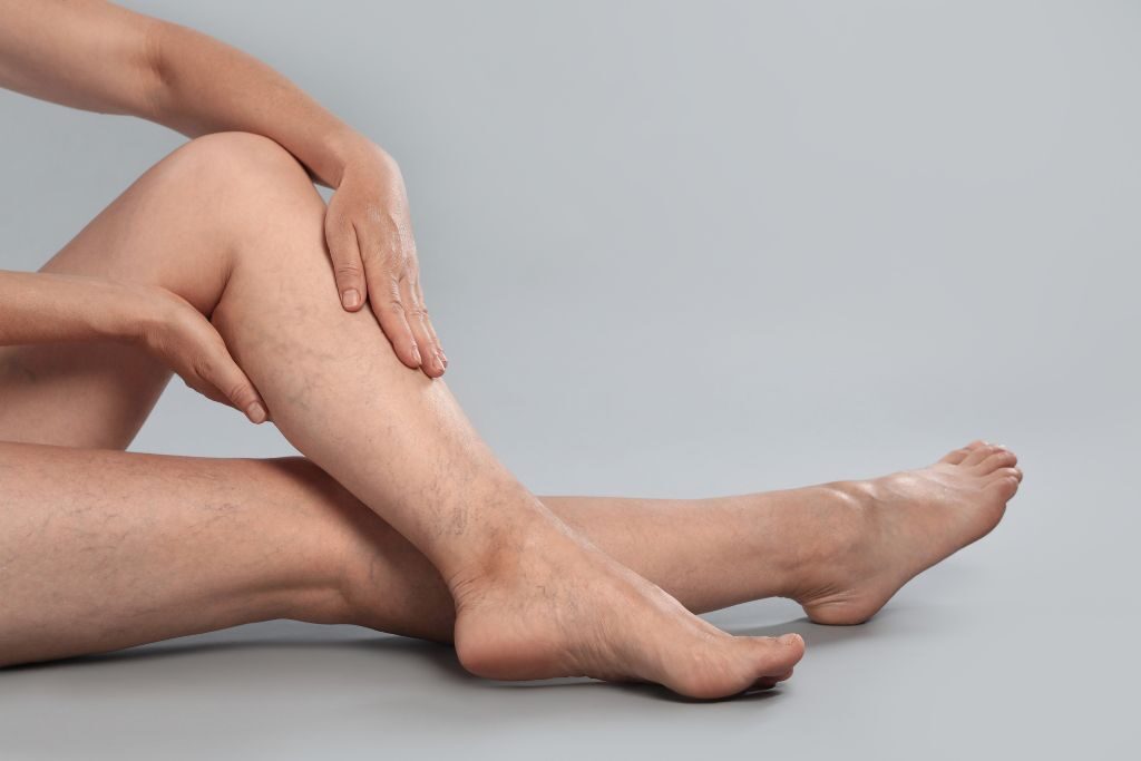 ¿Las varices vuelven a salir después de la fleboterapia? 1 vuelven a salir las varices fleboterapia