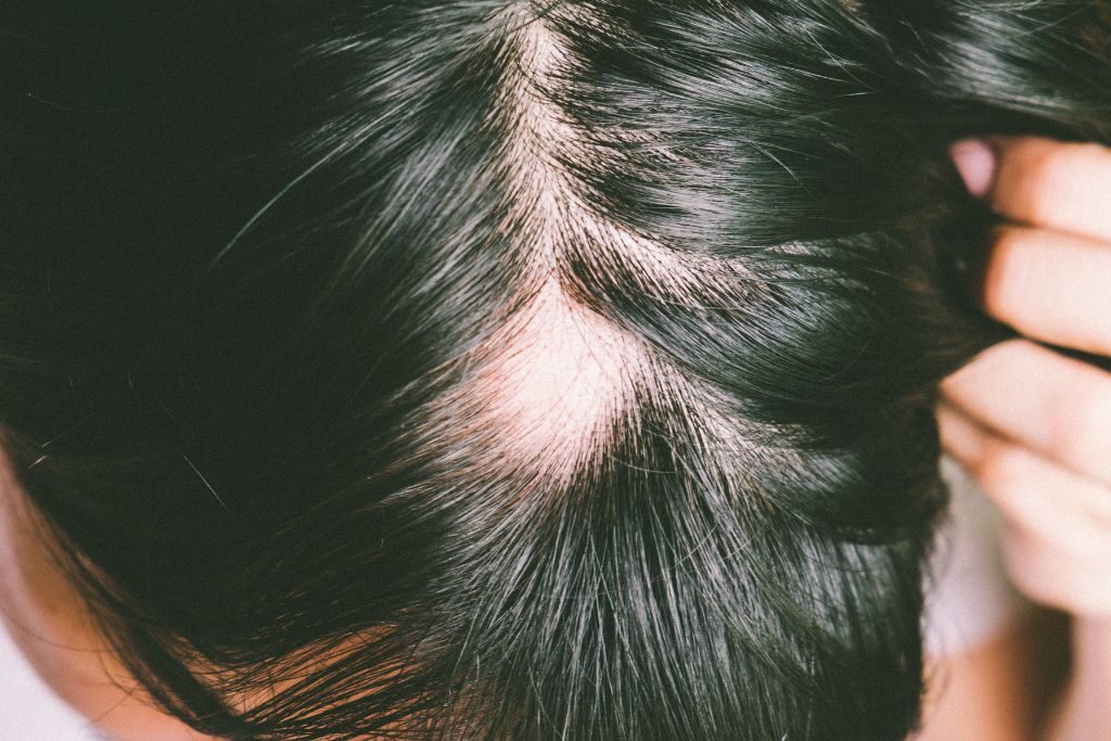 ¿Cómo se frena la alopecia androgenética? 1 Como se frena la alopecia androgenética