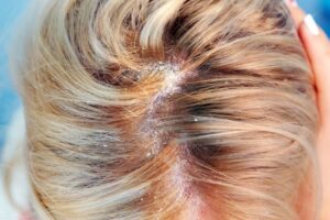 Señales de si tienes dermatitis seborreica