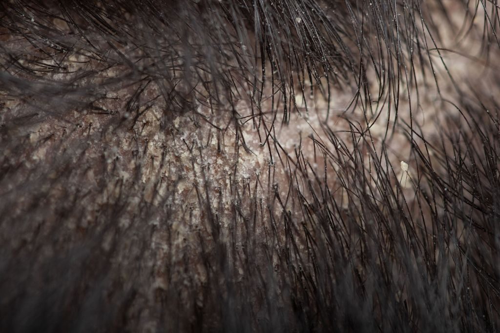 Señales de dermatitis seborreica: cómo reconocerla 1 Señales de dematitis seborreica