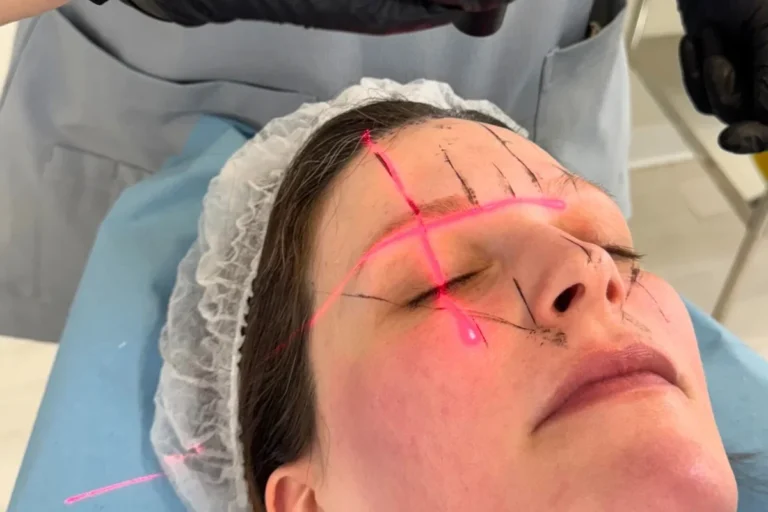 Marcaje del diseño de las cejas antes del injerto con técnica FUE Long Hair en GALA Unique