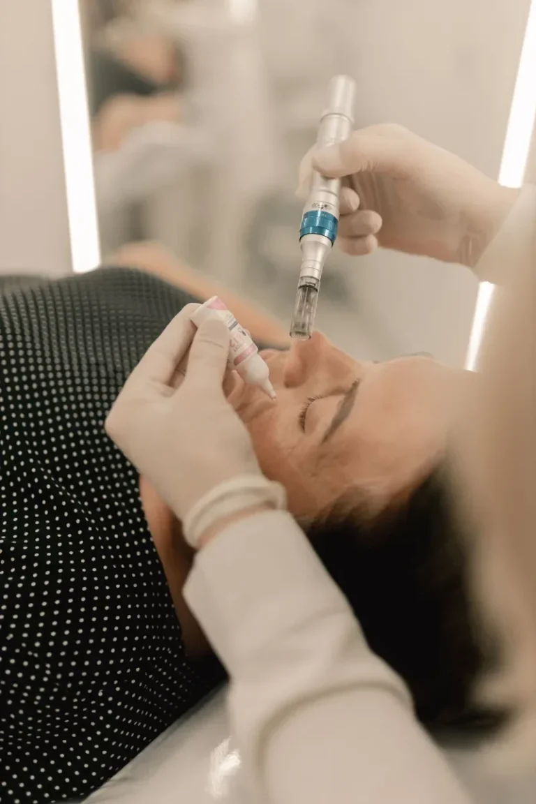 Aplicación de microagujas en el rostro durante un tratamiento de Morpheus 8