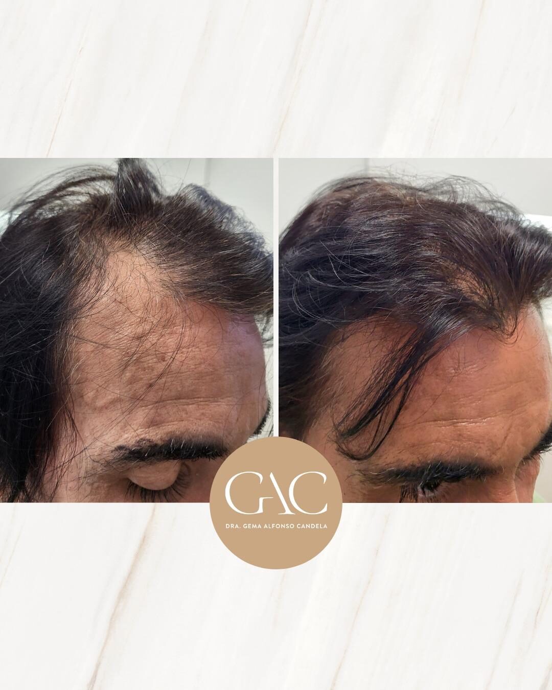 Exosomas capilares 1 exosomas capilares en hombre